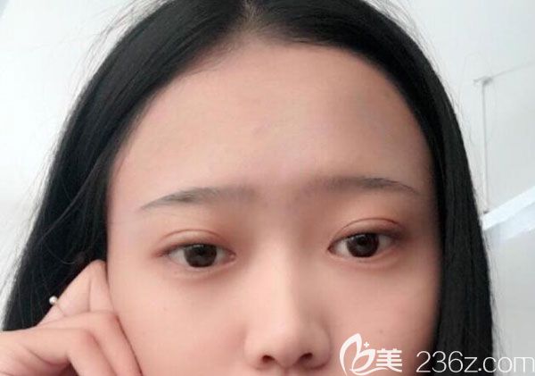 眼綜合雙眼皮術(shù)后20天不能化妝
