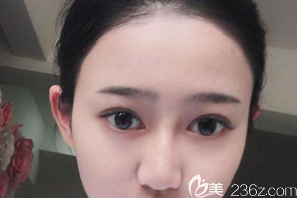 好開心喲！找昆明藝星金輝做眼綜合+提肌60天效果很自然，價格很合理