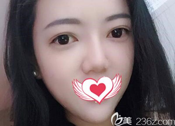 注射玻尿酸第3天感覺(jué)臉變大了