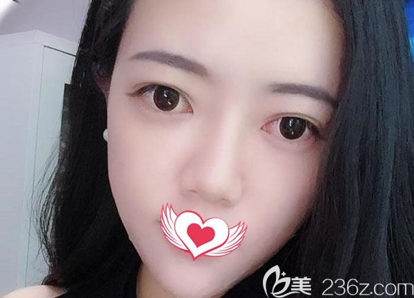 玻尿酸填充蘋果肌第7天摸著也沒(méi)有什么凹凸不平、硬塊的現(xiàn)象