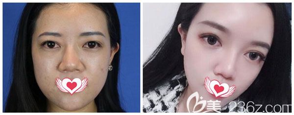 找昆明藝星白春燕用2支玻尿酸填充蘋果肌案例效果對比照，大家來評價一下怎么樣