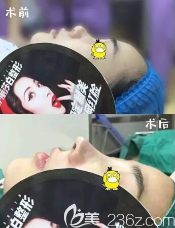 常德伊麗莎白整形醫(yī)院肋軟骨隆鼻真人案例前后對(duì)比效果