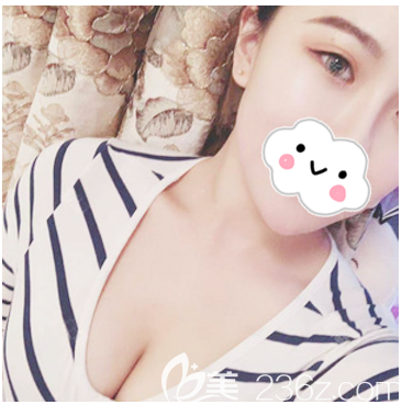 湛<!--<i data=20240703-sp></i>-->美豐胸案例1個(gè)月效果告訴你湛江隆胸哪家醫(yī)院好 湛<!--<i data=20240703-sp></i>-->美豐胸案例1個(gè)月效果告訴你湛江隆胸哪家醫(yī)院好