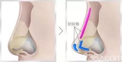 肋軟骨隆鼻效果好嗎？取肋軟骨隆鼻對(duì)身體有害嗎？