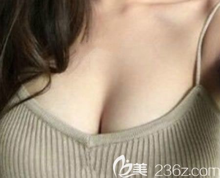 看了贛州韓美整形醫(yī)院隆胸真人實(shí)例和價(jià)格后，我做了290CC傲諾拉假體隆胸很滿意