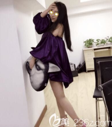 在百嘉麗做全身吸脂術(shù)后50天恢復(fù)效果 在百嘉麗做全身吸脂術(shù)后50天恢復(fù)效果