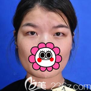 面診徐州時(shí)光洪揚(yáng)術(shù)前單眼皮 面診徐州時(shí)光洪揚(yáng)術(shù)前單眼皮