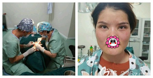 找徐州時(shí)光洪揚(yáng)醫(yī)生剛做完雙眼皮+開(kāi)眼角 找徐州時(shí)光洪揚(yáng)醫(yī)生剛做完雙眼皮+開(kāi)眼角