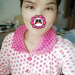 術(shù)后第二天雙眼皮+開(kāi)眼角恢復(fù) 術(shù)后第二天雙眼皮+開(kāi)眼角恢復(fù)