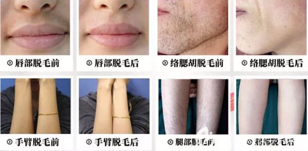 酒泉華美脫唇毛、脫腿毛、手臂脫毛效果怎么樣