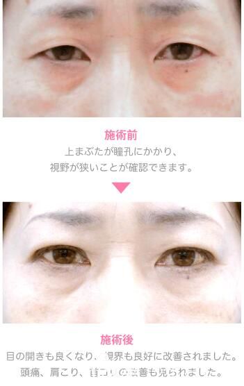 竹內(nèi)重夫上瞼下垂案例