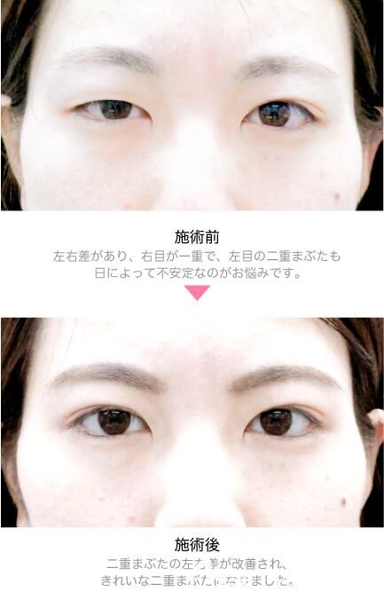 竹內(nèi)重夫雙眼皮部分切開(kāi)法案例