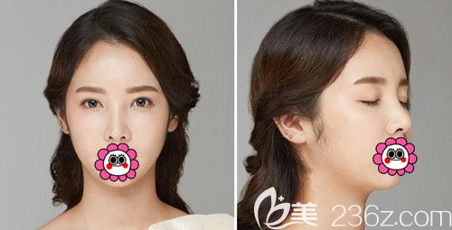 在韓國POP整形醫(yī)院做鼻綜合＋全切雙眼皮修復+全臉脂肪填充半年效果