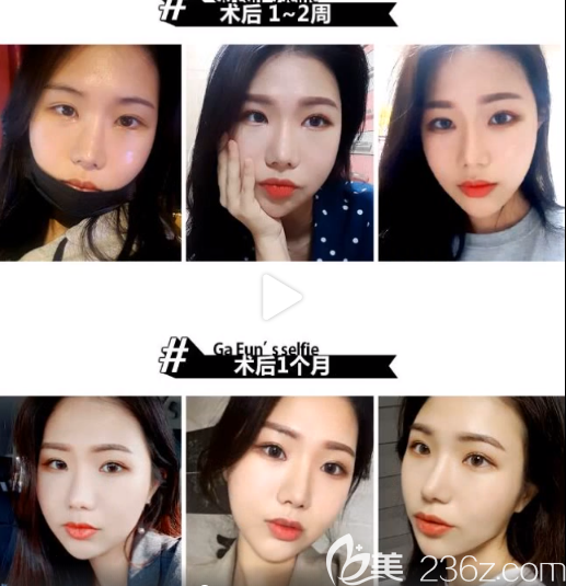 臉本臉骨整形外科facebone樸用南怎么樣 臉本臉骨整形外科facebone樸用南怎么樣