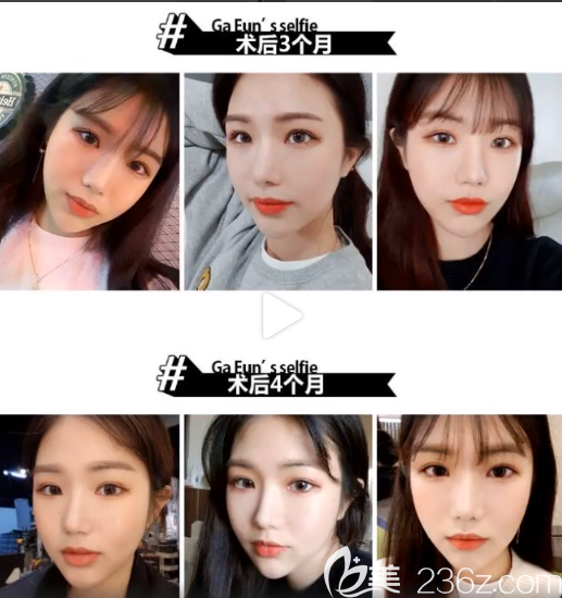 臉本臉骨整形外科樸用南顴骨案例 臉本臉骨整形外科樸用南顴骨案例