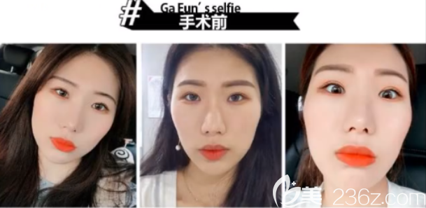 臉本臉骨整形外科facebone怎么樣 臉本臉骨整形外科facebone怎么樣