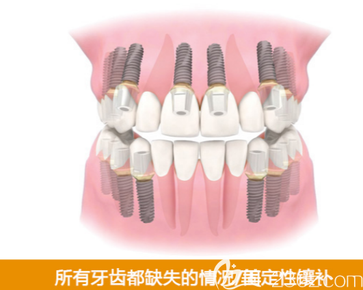 韓國來一菲LIVE牙科醫(yī)院所有牙齒都缺失治療辦法