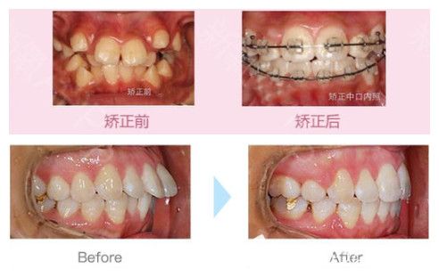 重慶齊美牙齒畸形及成人深覆蓋矯正案例效果 重慶齊美牙齒畸形及成人深覆蓋矯正案例效果