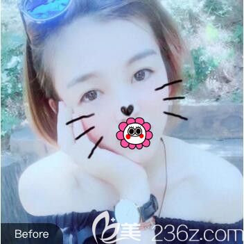 在沈陽(yáng)名流做雙眼皮+脂肪填充額頭術(shù)前照 在沈陽(yáng)名流做雙眼皮+脂肪填充額頭術(shù)前照