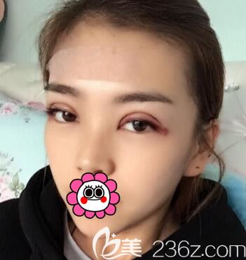 雙眼皮+自體脂肪額頭填充術(shù)后3天照 雙眼皮+自體脂肪額頭填充術(shù)后3天照