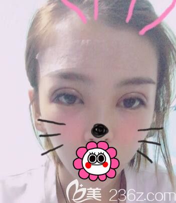 割雙眼皮+額頭脂肪填充術(shù)后一周效果 割雙眼皮+額頭脂肪填充術(shù)后一周效果