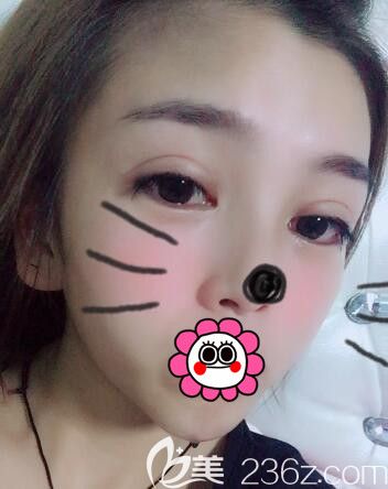 沈陽(yáng)雙眼皮+自體脂肪額頭填充術(shù)后半個(gè)月效果 沈陽(yáng)雙眼皮+自體脂肪額頭填充術(shù)后半個(gè)月效果