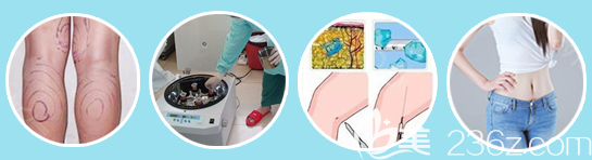 廣州星團(tuán)醫(yī)美趙輝醫(yī)生吸脂手術(shù)過(guò)程圖