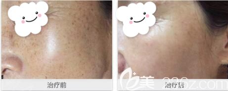 安琪兒整形皮秒激光美膚術(shù)前術(shù)后對比效果