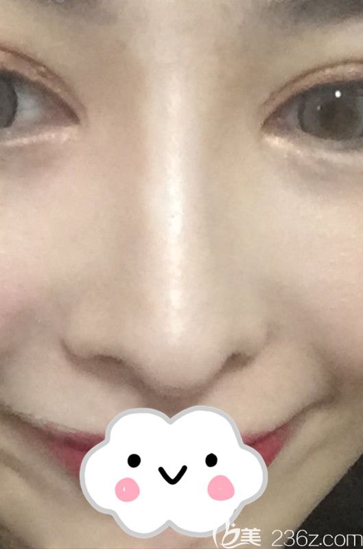 韓國娜娜整形外科醫(yī)院金亨俊院長隆鼻失敗修復(fù)真人案例 韓國娜娜整形外科醫(yī)院金亨俊院長隆鼻失敗修復(fù)真人案例