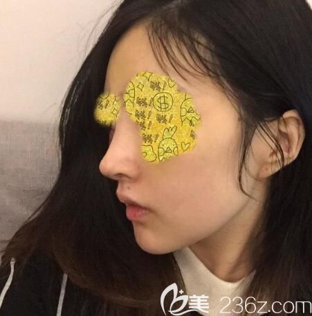 韓國nano整形醫(yī)院金亨俊自體肋軟骨隆鼻修復(fù)矯正歪鼻案例 韓國nano整形醫(yī)院金亨俊自體肋軟骨隆鼻修復(fù)矯正歪鼻案例