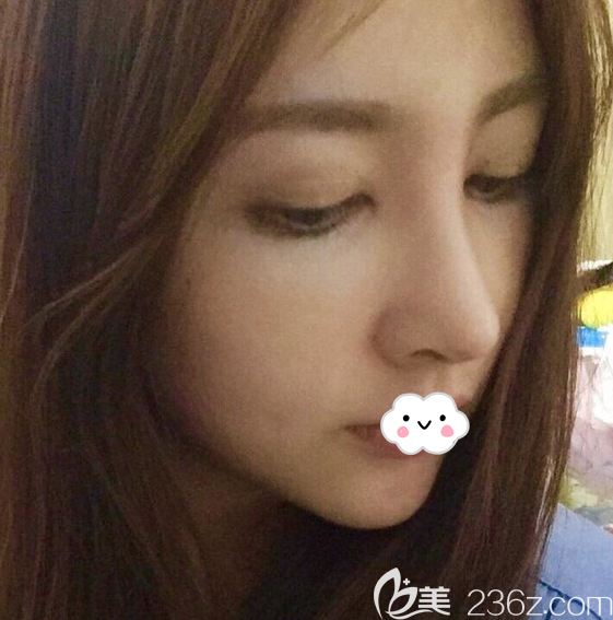 韓國娜娜整形醫(yī)院隆鼻失敗修復(fù)案例恢復(fù)過程圖 韓國娜娜整形醫(yī)院隆鼻失敗修復(fù)案例恢復(fù)過程圖