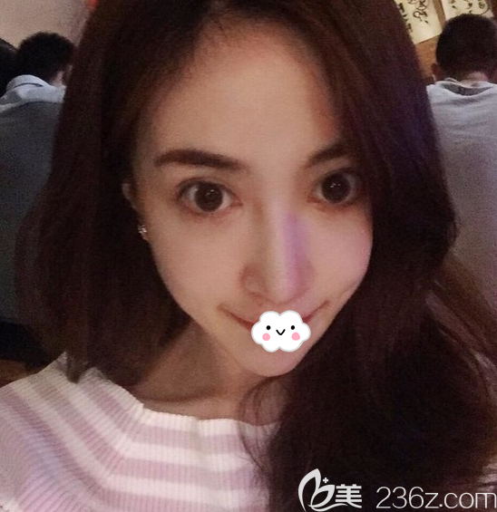 韓國nano整形醫(yī)院金亨俊隆鼻失敗修復(fù)案例術(shù)后3個(gè)月恢復(fù)照片 韓國nano整形醫(yī)院金亨俊隆鼻失敗修復(fù)案例術(shù)后3個(gè)月恢復(fù)照片