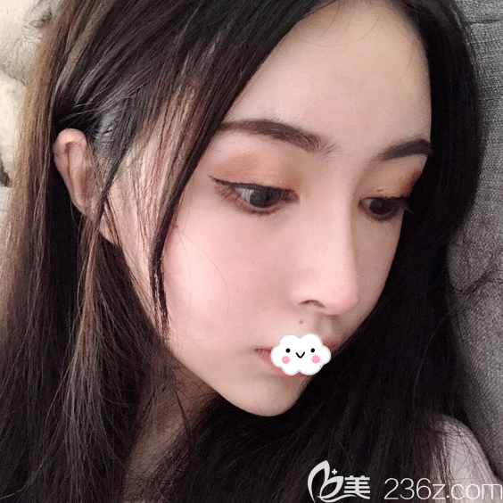 鼻綜合失敗找韓國(guó)娜娜整形醫(yī)院金亨俊做自體軟骨隆鼻修復(fù),看韓國(guó)nana鼻子做得高嗎