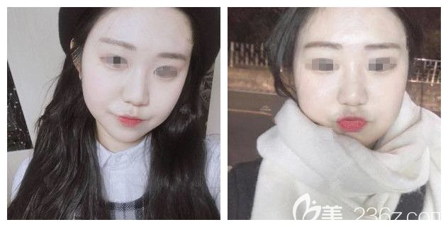 面診常州美貝爾醫(yī)生術(shù)前嘟嘟臉 面診常州美貝爾醫(yī)生術(shù)前嘟嘟臉