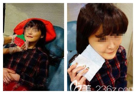 醫(yī)生十幾分鐘瘦臉注射后冰敷 醫(yī)生十幾分鐘瘦臉注射后冰敷