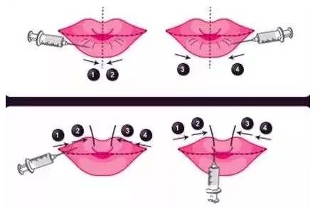 韓國(guó)注射嘟嘟唇 韓國(guó)注射嘟嘟唇