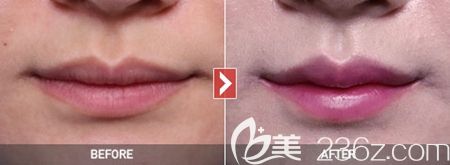 韓國(guó)女神整形外科微笑唇案例 韓國(guó)女神整形外科微笑唇案例