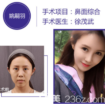 徐茂武醫(yī)生的隆鼻案例