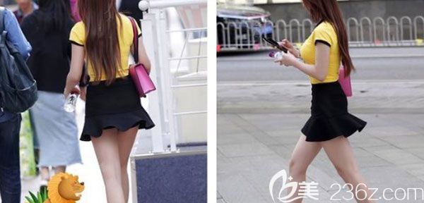  找昆明夢想李成龍做大腿吸脂兩個月的效果，終于可以讓我朝著模特邁步了