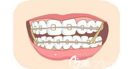 丁建宇醫(yī)生解答做牙齒矯正的合適年齡 丁建宇醫(yī)生解答做牙齒矯正的合適年齡