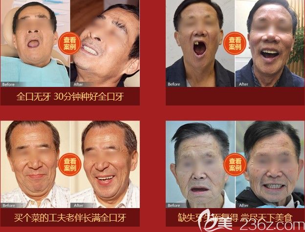 長沙中諾立得用全口種植牙及無牙頜種植牙案例效果