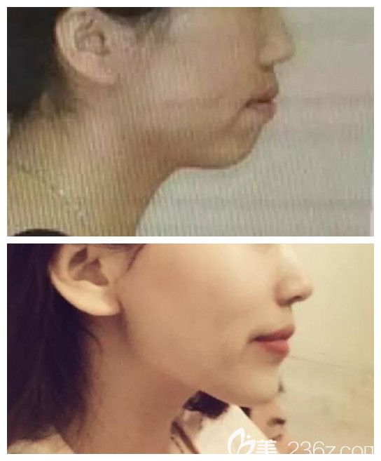 齙牙摘牙套后側面對比圖 齙牙摘牙套后側面對比圖