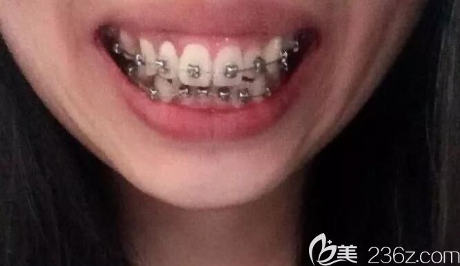 盛大口腔正畸過程中牙齒的變化 盛大口腔正畸過程中牙齒的變化