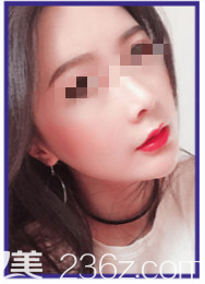 分享我在煙臺華怡整形醫(yī)院隆鼻共30天的恢復過程