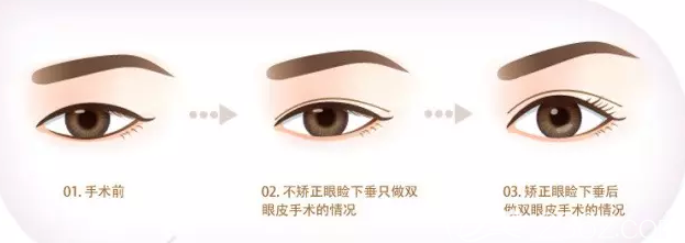 上瞼下垂矯正后雙眼皮手術(shù)效果 上瞼下垂矯正后雙眼皮手術(shù)效果