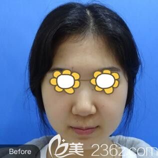 在沈陽名流做鼻整形術(shù)前照 在沈陽名流做鼻整形術(shù)前照