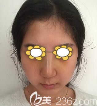 做假體隆鼻術(shù)后即刻效果展示 做假體隆鼻術(shù)后即刻效果展示