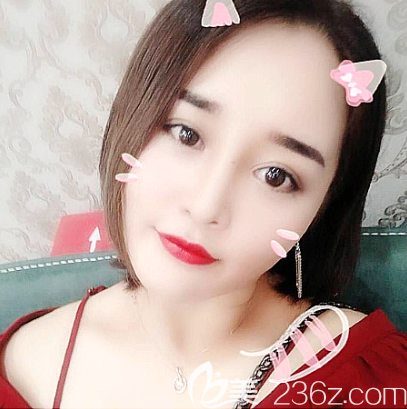 我去佛山夢露找孫文娜醫(yī)生做完雙眼皮隆鼻后又做了面部吸脂和祛痘,大家看效果怎么樣