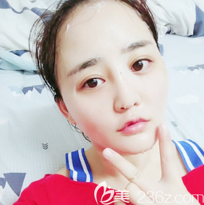 佛山夢(mèng)露雙眼皮隆鼻面部吸脂和祛痘兩個(gè)月圖片 佛山夢(mèng)露雙眼皮隆鼻面部吸脂和祛痘兩個(gè)月圖片