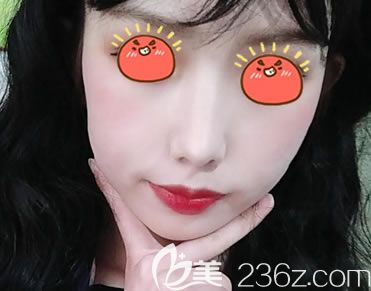 寧波美萊孫明磊隆鼻案例21天效果